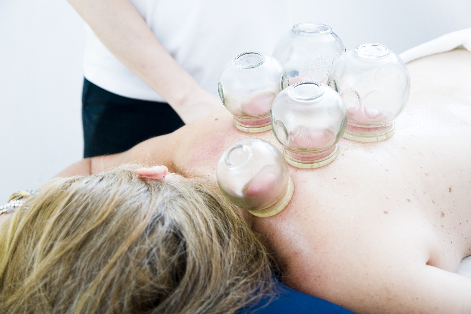 a caucasian blond woman lays face down on a table with cups on her back while receiving cupping therapy